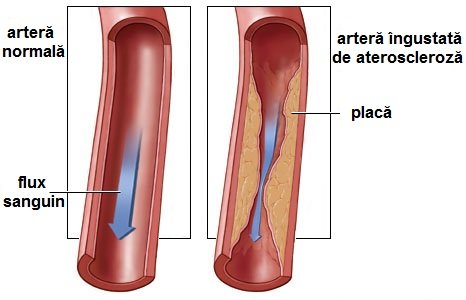 Ateroscleroza.