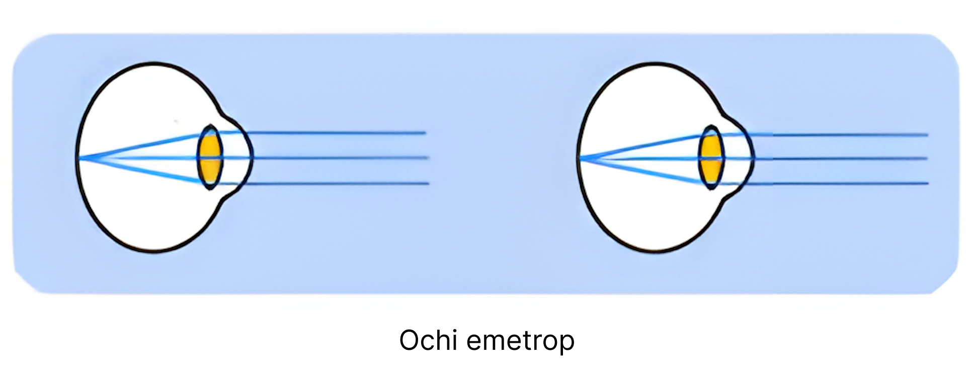 Ochiul emetrop.